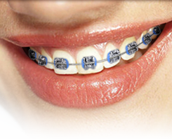 metal braces